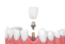 stop-living-with-gaps:-explore-dental-implants-brisbane-for-a-permanent-solution