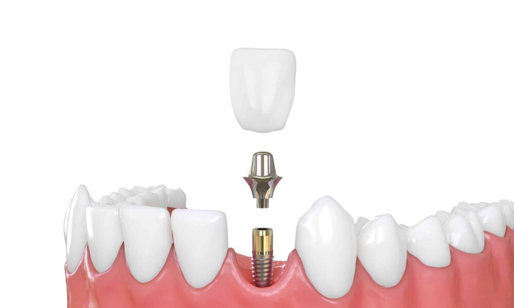 stop-living-with-gaps:-explore-dental-implants-brisbane-for-a-permanent-solution